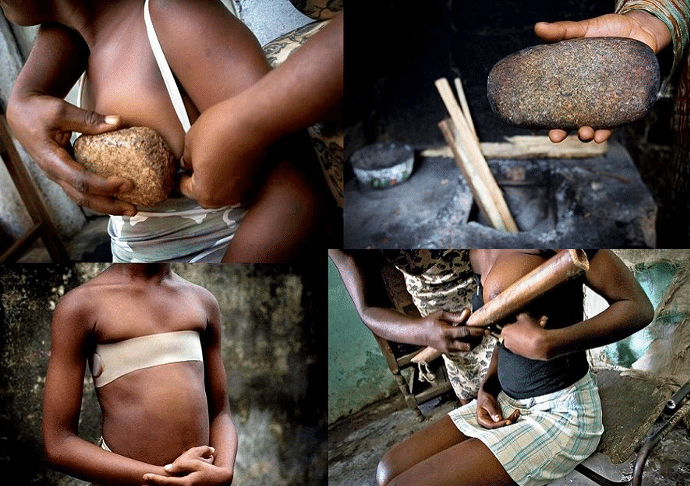 L’aplatissement des seins, pratique aberrante contre les filles, toujours au 21ème siècle L’aplatissement des seins, pratique aberrante contre les filles, toujours au 21ème siècle