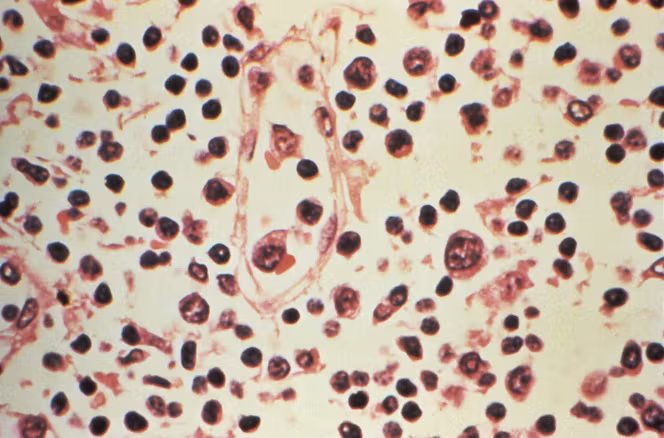 Coupe d’un prélèvement de ganglion lymphatique effectué sur un patient suspecté d’être atteint d’une infection à hantavirus, le 6 mai 2026.
