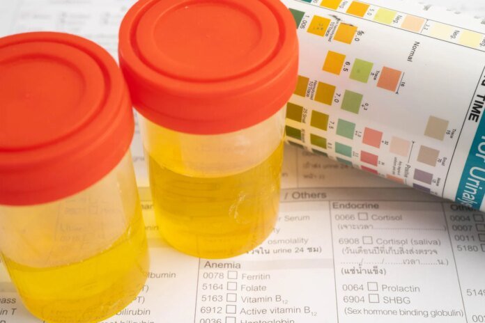 Analyse d'urine : 6 indicateurs qui doivent vous alerter après 50 ans