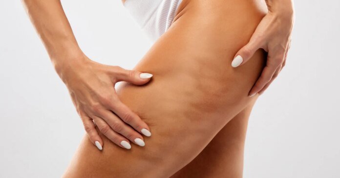 Cellulite : 3 produits testés et validés par la rédaction pour diminuer les capitons !