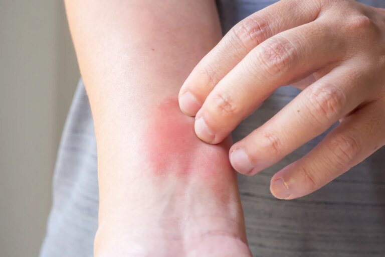 Ni allergie, ni piqûre, ni eczéma : ces plaques sur la peau ou dans la bouche indiquent une maladie auto immune peu connue