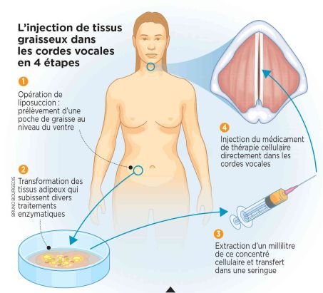 5 millions de cellules environ seront contenues dans la seringue de 1 millilitre préparée pour le patient. L\'injection peut être renouvelée après six mois en cas d\'insuccès.