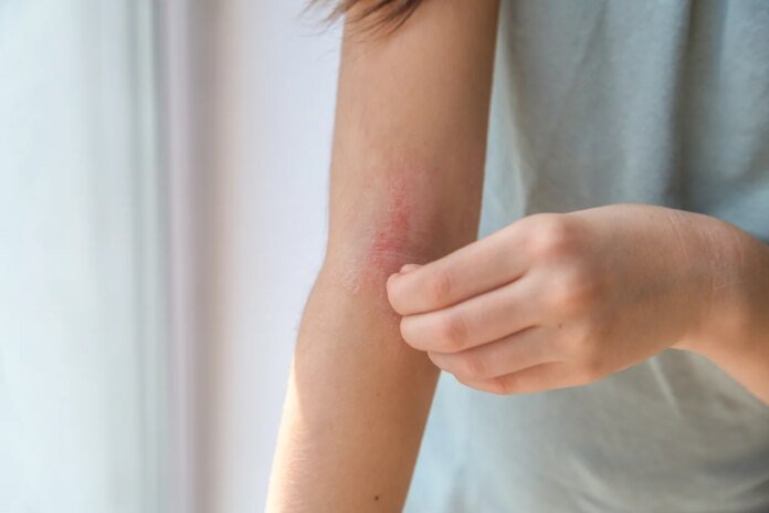 Chaleur et peau : 5 gestes anodins en été qui favorisent l’intertrigo, un problème pénible à vivre !