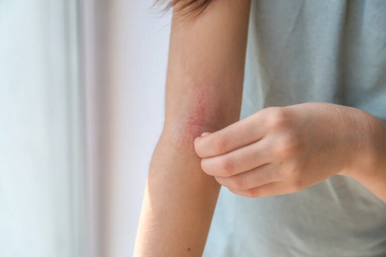 Chaleur et peau : 5 gestes anodins en été qui favorisent l’intertrigo, un problème pénible à vivre !
