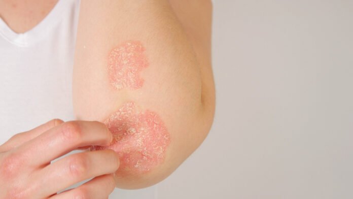 Psoriasis : un nouveau traitement innovant mis au point par une équipe française, il promet une guérison complète