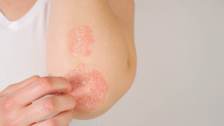 Psoriasis : un nouveau traitement innovant mis au point par une équipe française, il promet une guérison complète